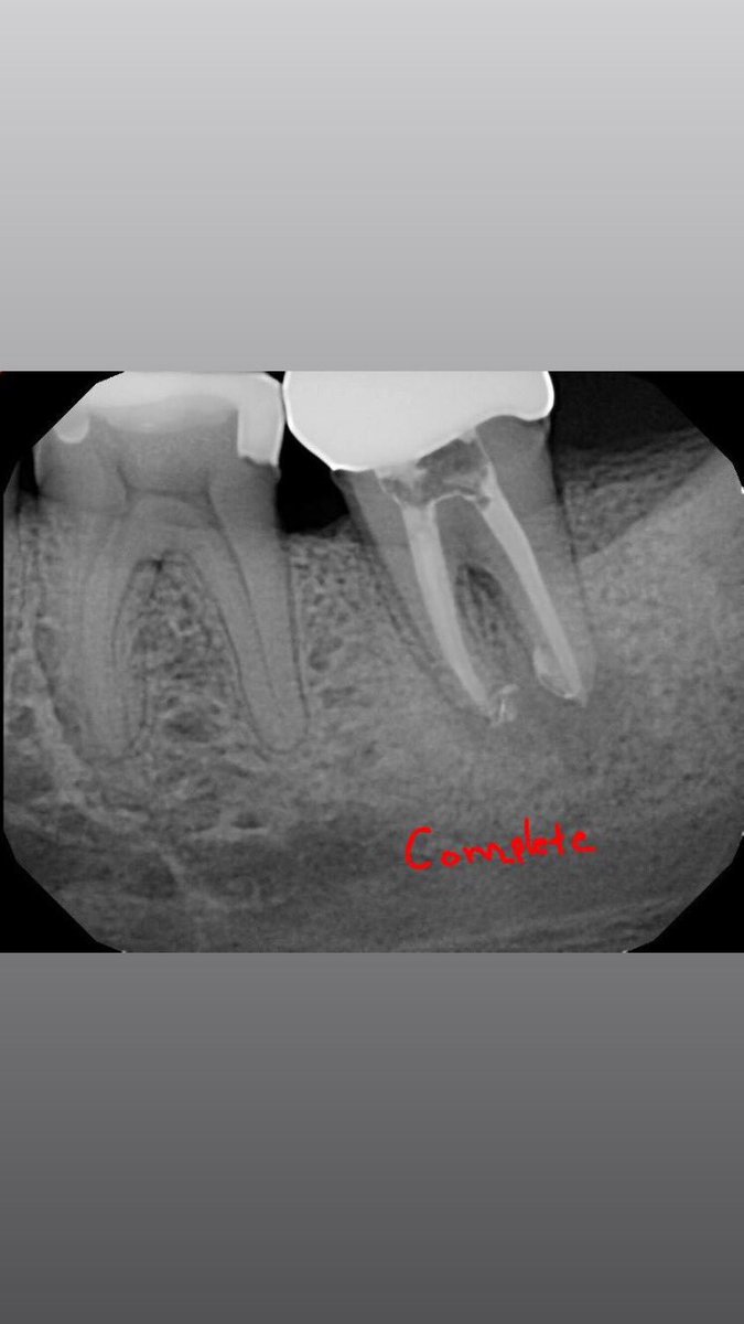 DrRicoShort's tweet photo. The SHORT Case Of The Day!
Retreatment on Tooth #18
#WorthSaving
#RelaxDontExtract https://t.co/KihJCQN1jx