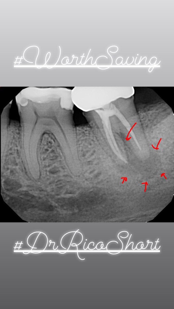 DrRicoShort's tweet photo. The SHORT Case Of The Day!
Retreatment on Tooth #18
#WorthSaving
#RelaxDontExtract https://t.co/KihJCQN1jx