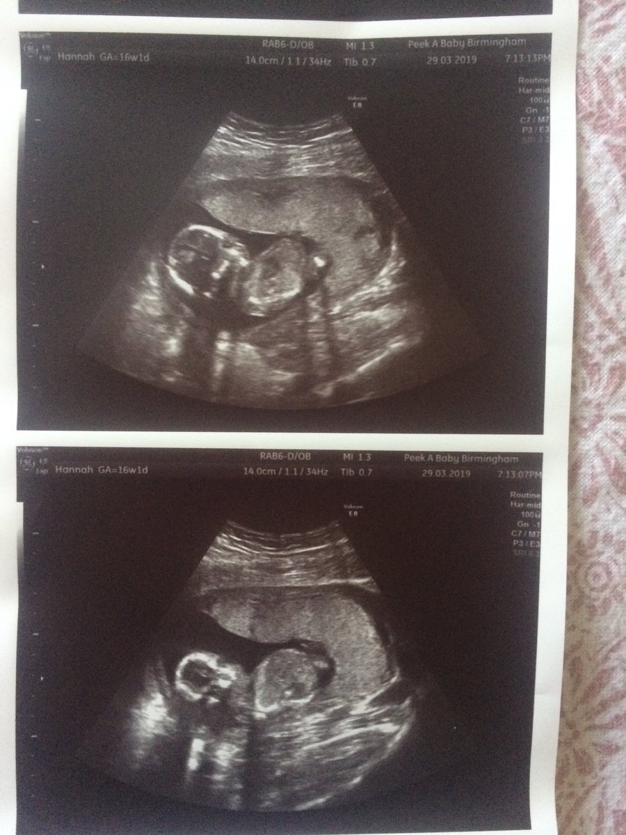 Hannahrodger95's tweet photo. expecting a little boy 14th September 💙🥰😁 https://t.co/UudUFzrV3B