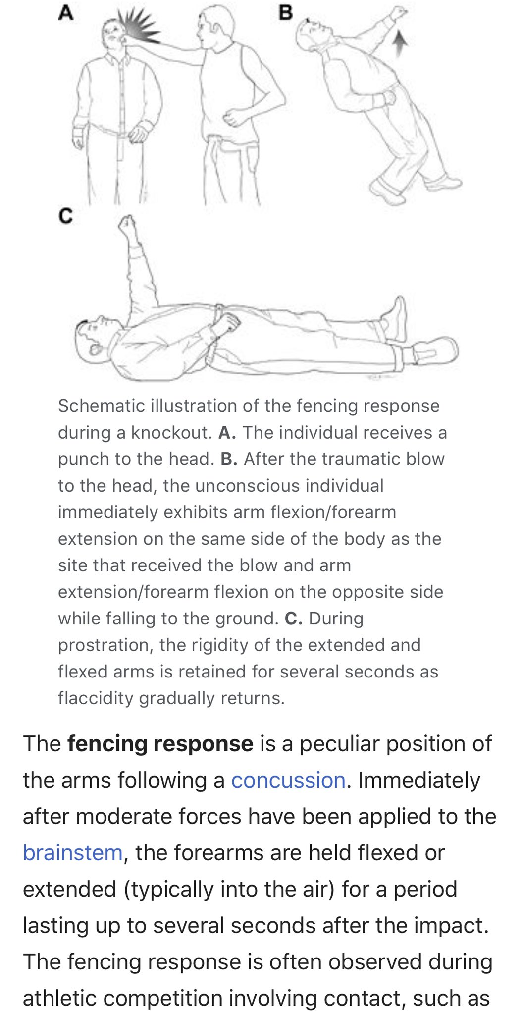 28+ Fencing response head injury