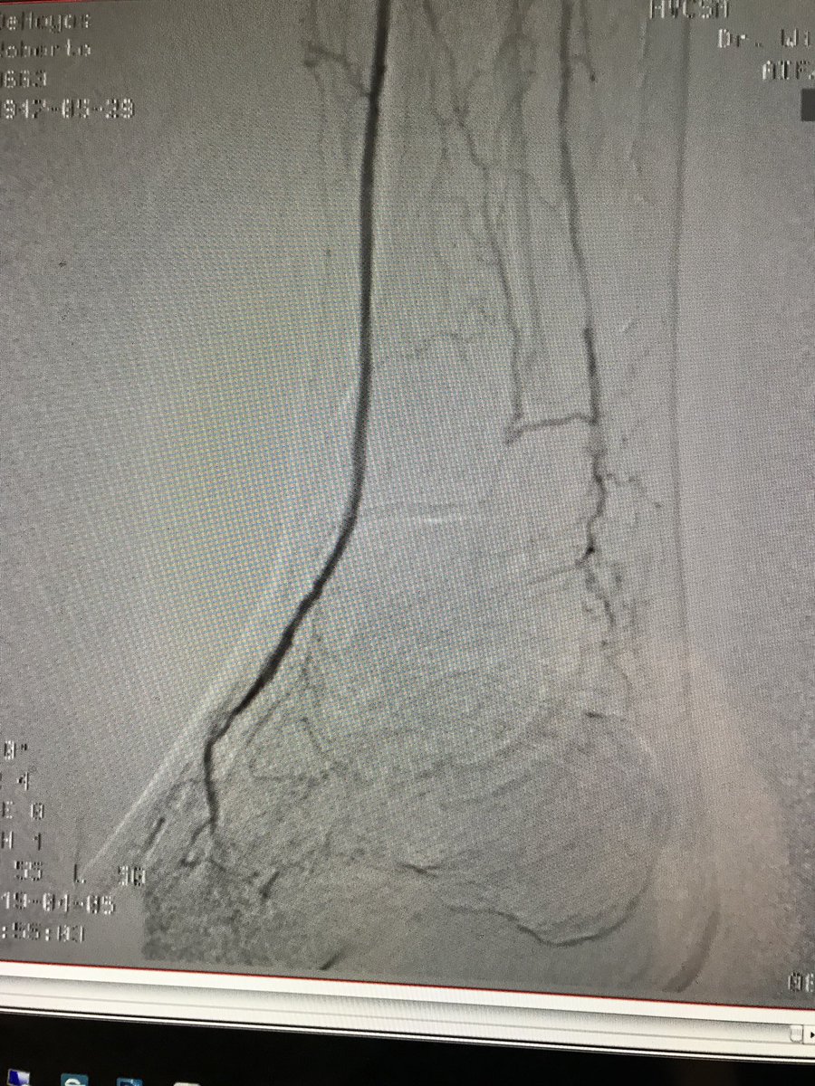 WilliamWuHVC's tweet photo. 71 y/o make w/ HTN, DM, CAD S/P CABG, severe PVD with non-healing ulcer RLE. 

AKA/BKA considered; however, 
#clifighters.  Angio showed CTO popliteal artery and diffuse disease of AT, PT and Peroneal artery.

Below knee/ankle #CSI360 and PTA.
@SAIFSanAntonio @jackleonard8705 https://t.co/YA7qHsuap5
