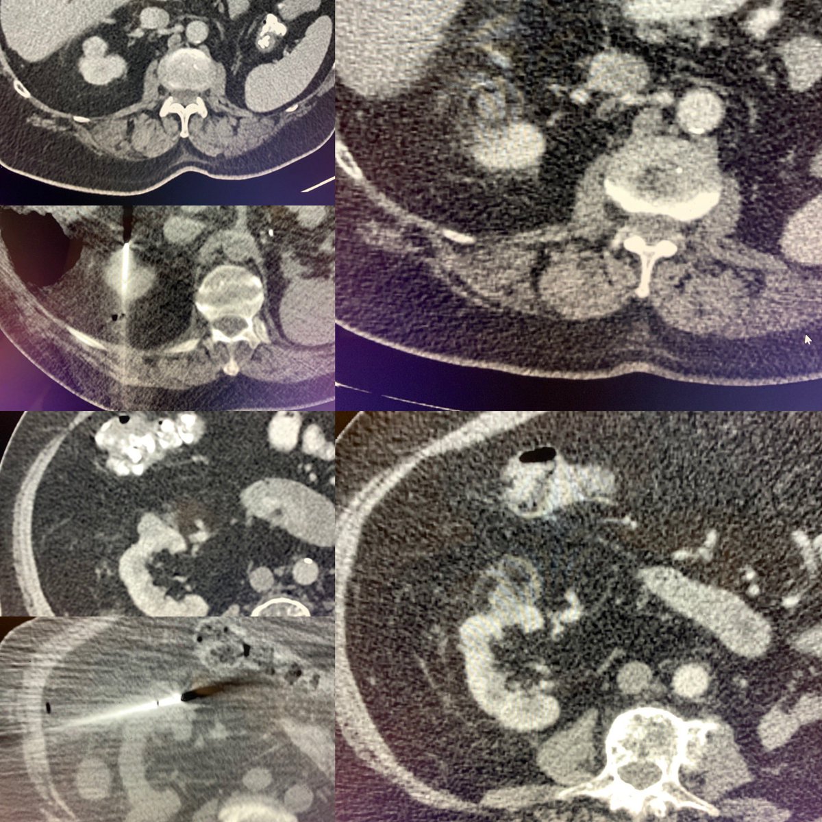 AustinBourgeois's tweet photo. Patient with remote left #nephrectomy for #kidney #cancer.  Three new, separate masses in the right kidney. Baseline creatinine of 1.9. All three masses treated with biopsy &amp; #cryoablation in 2 sessions.  3 month scan looking good! Creatinine 1.75 at followup clinic visit. #iRad https://t.co/YTiB1ftzkn