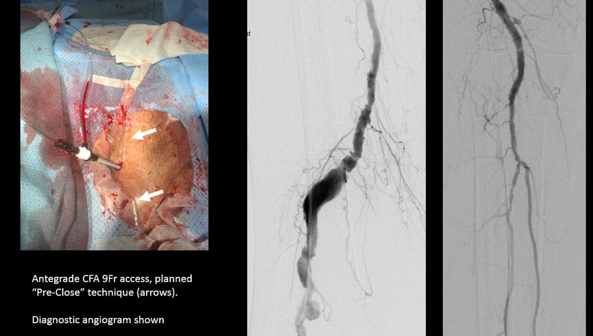 SDhandMD's tweet photo. 89yo w acute severe pain in R knee, pulsating mass noted.  Due to age &amp; comorbid -> deemed as nonsurgical candidate. 

#endovascular fix using 9F antegrade CFA, SGs, &amp; preclose 

happy patient @ 6 mo FU
 
@kmadass @AlexCVIR @LessneVIR @DanHan @rkryu @p_oconnor1 @Watts_IR @SIRRFS https://t.co/L67dKele0B
