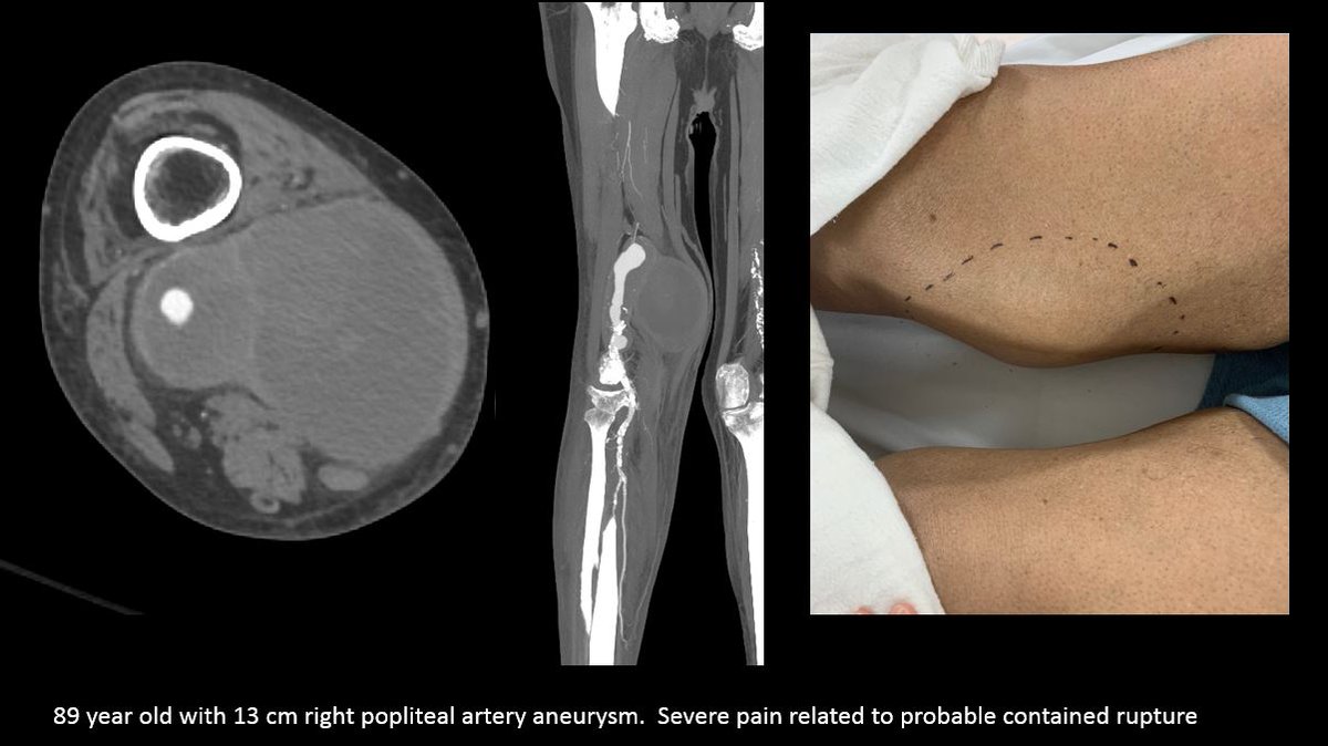 SDhandMD's tweet photo. 89yo w acute severe pain in R knee, pulsating mass noted.  Due to age &amp; comorbid -> deemed as nonsurgical candidate. 

#endovascular fix using 9F antegrade CFA, SGs, &amp; preclose 

happy patient @ 6 mo FU
 
@kmadass @AlexCVIR @LessneVIR @DanHan @rkryu @p_oconnor1 @Watts_IR @SIRRFS https://t.co/L67dKele0B