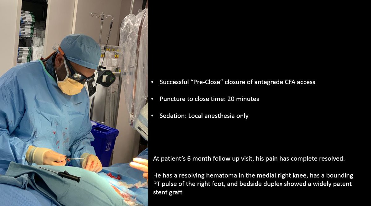 SDhandMD's tweet photo. 89yo w acute severe pain in R knee, pulsating mass noted.  Due to age &amp; comorbid -> deemed as nonsurgical candidate. 

#endovascular fix using 9F antegrade CFA, SGs, &amp; preclose 

happy patient @ 6 mo FU
 
@kmadass @AlexCVIR @LessneVIR @DanHan @rkryu @p_oconnor1 @Watts_IR @SIRRFS https://t.co/L67dKele0B