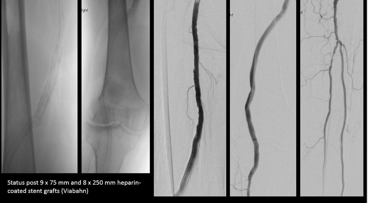 SDhandMD's tweet photo. 89yo w acute severe pain in R knee, pulsating mass noted.  Due to age &amp; comorbid -> deemed as nonsurgical candidate. 

#endovascular fix using 9F antegrade CFA, SGs, &amp; preclose 

happy patient @ 6 mo FU
 
@kmadass @AlexCVIR @LessneVIR @DanHan @rkryu @p_oconnor1 @Watts_IR @SIRRFS https://t.co/L67dKele0B
