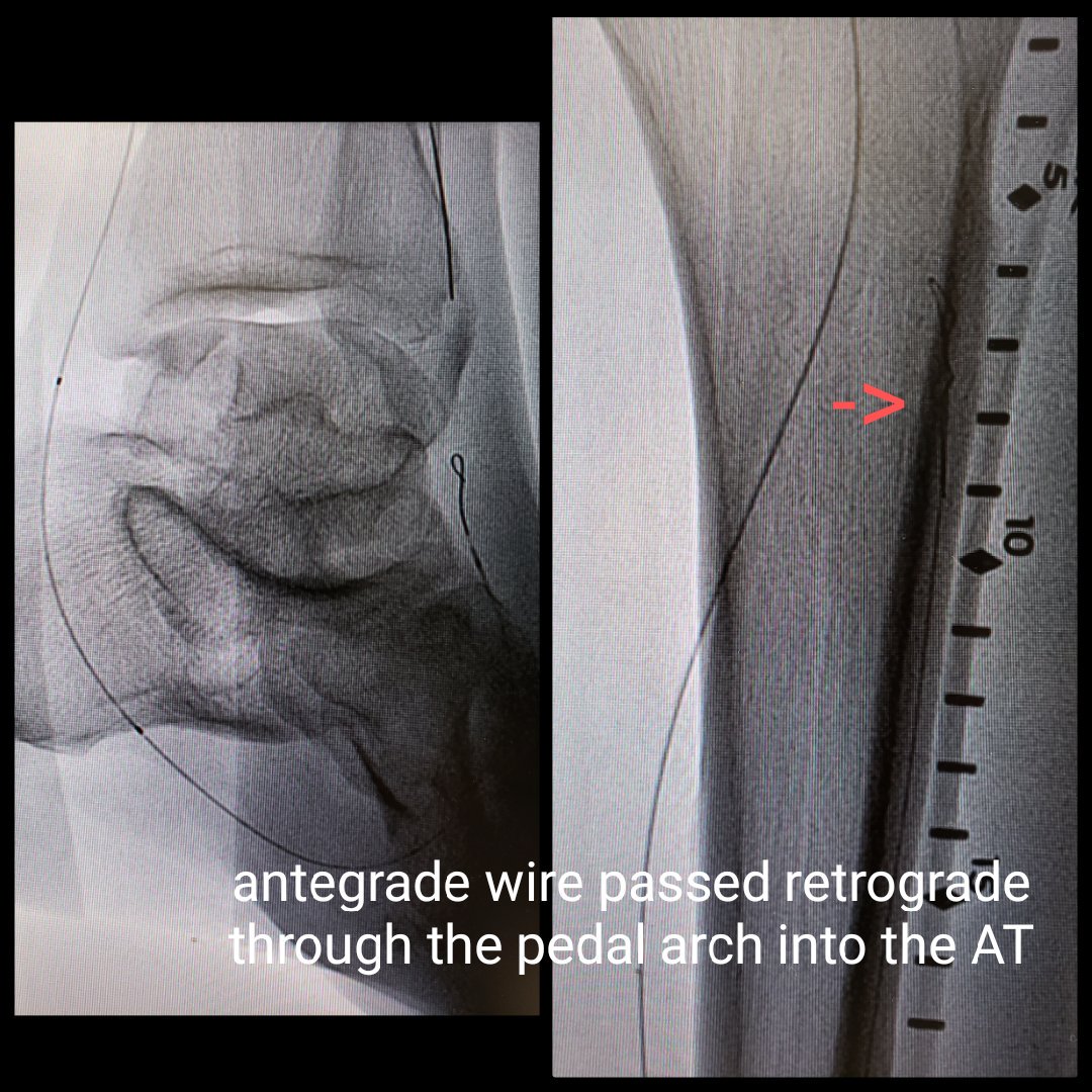 JVargheseMD's tweet photo. #CLIFighters RFC 5, 3rd toe ulcer, multi CTOs. Crossed pop antegrade and wired through pedal arch into AT but catheter or balloons would not track through the arch. Wire from AT went in dissection at d CTO. What would you do? @Mustapja @FadiSaab17 @kmadass @SDhandMD @baileyannRN https://t.co/4XgiT3PuuI