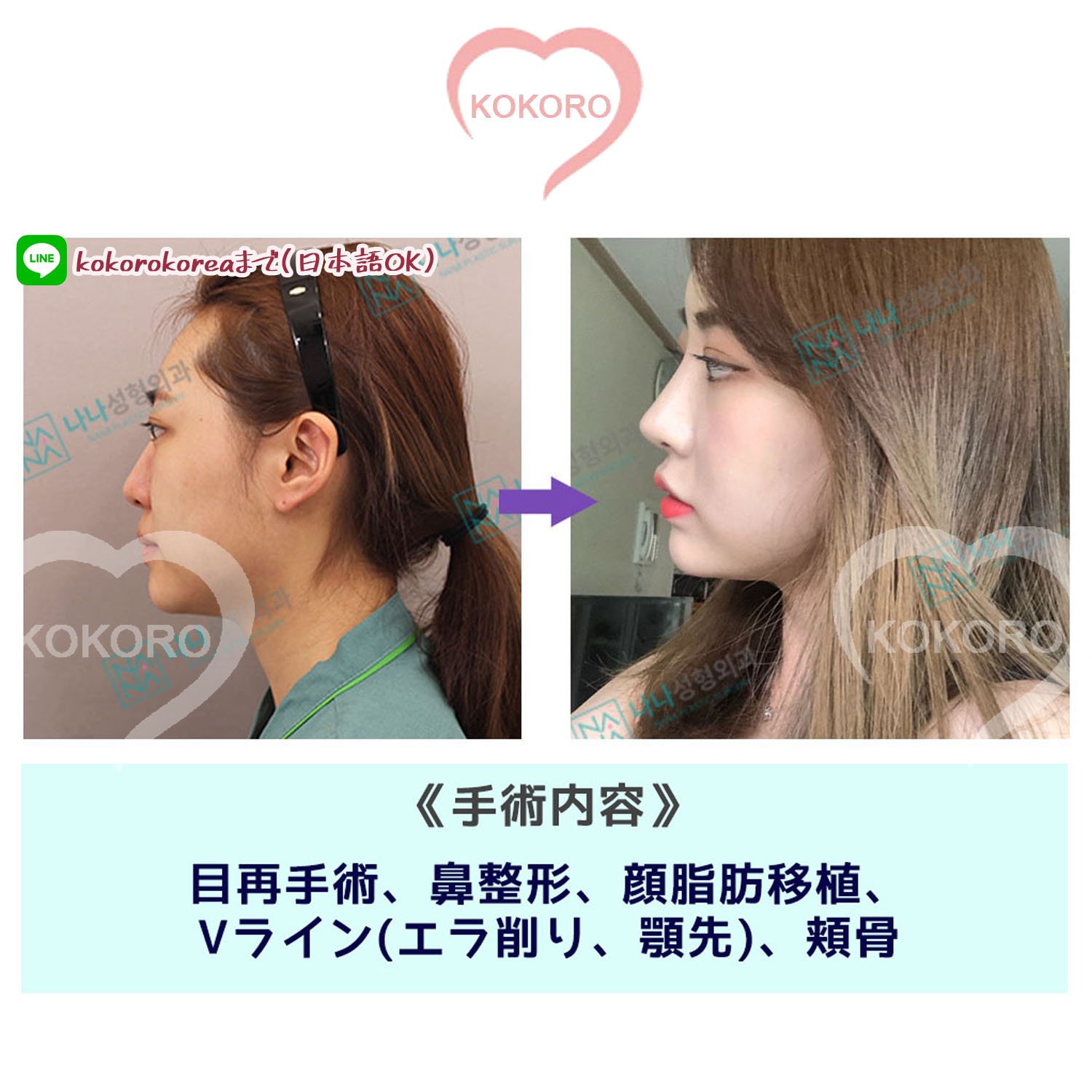 Kokoro 頬骨 エラ削り 目再手術 鼻整形 Nana整形外科 で韓国アイドルのようなお顔を手に入れませんか 気になる方は Line Kokorokorea までお願い致します 韓国美容整形 プチ整形 男性 オルチャン 美男美女 Kokoro 頬骨 エラ削り 目再手術 鼻整形 Nana整形外科 で韓国アイドルのようなお顔を手に入れませんか 気になる方は Line Kokorokorea までお願い致します 韓国美容整形 プチ整形 男性 オルチャン 美男美女