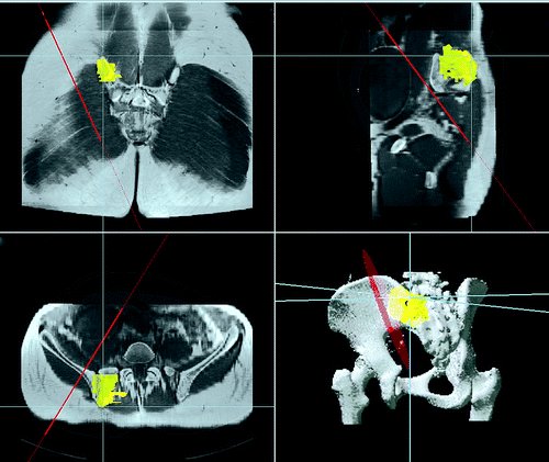 BoneJointJ's tweet photo. Is computer navigation when used in the surgery of iliosacral pelvic bone tumours safer for the patient? Recent article suggests it has increased the safety for patients and allows for a better oncological outcome https://t.co/hx60kmXbbD #computernavigation #bonetumours https://t.co/WmUGHziieP
