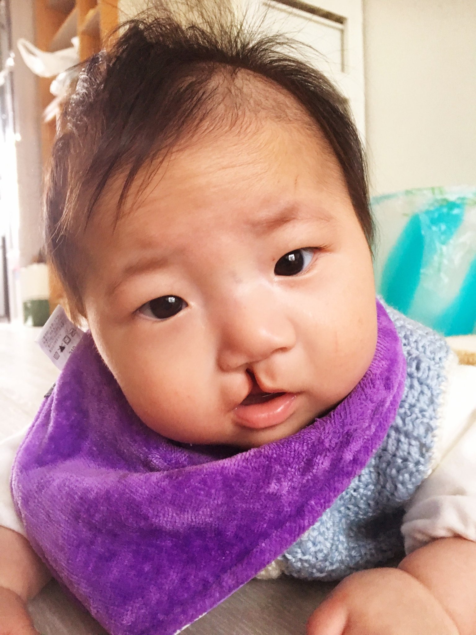 斑镸 ウチの子 子班長のビフォーアフターをご紹介します 口唇 口蓋裂で今日唇を縫い合わせる手術から帰ってきました 次は上顎を埋める手術をします Before After 口唇口蓋裂 T Co Z8vac0mwks Twitter