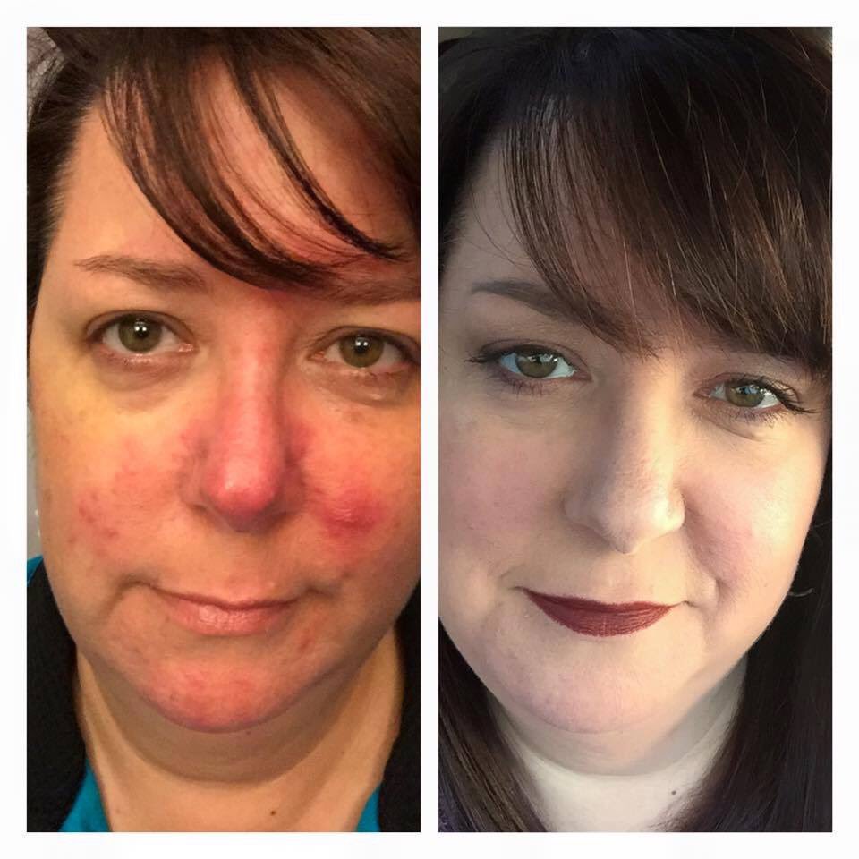 MrsAshleyDotson's tweet photo. Shut the front door!!! Y’all!!!! Look at this coverage!!!
“I have Rosacea that results in very painful cystic breakouts. The Flawless Four has changed my life, my look and how I feel about myself in my skin! I use Velour Concealer and Chiffon Foundation.” https://t.co/I81ERcdUyn