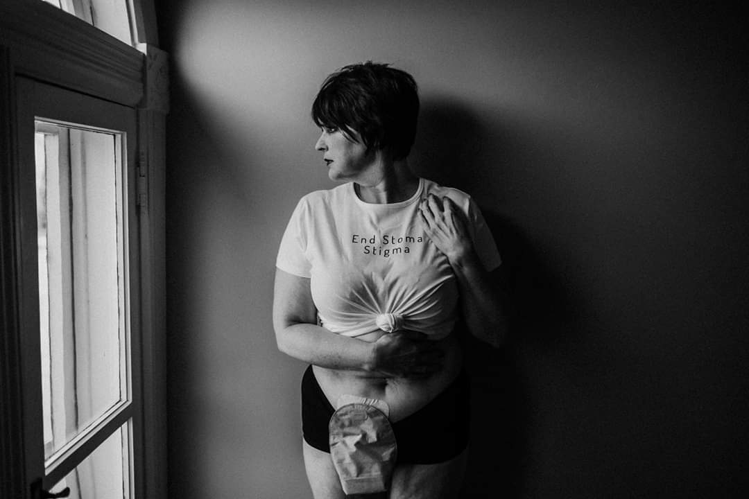 Ostomy Awareness 
#ScarsofHope #ostomylife #ileostomy #endstomastigma