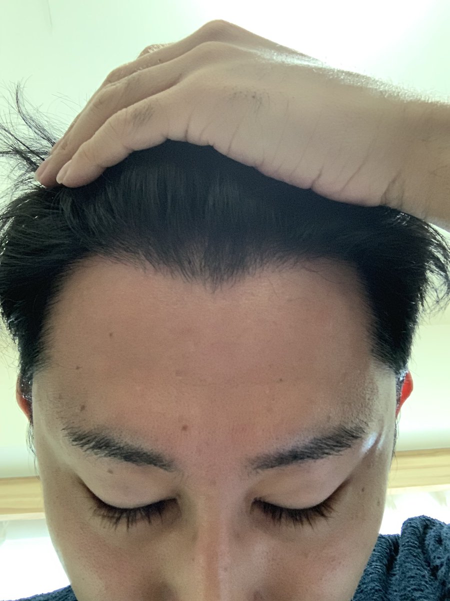 ハゲリーマンちゃんねる 毛髪診断士 ハゲ対策系youtuber در توییتر 18年5月 中国でm字部分に植毛して来ました 後頭部の髪の毛を前髪の生え際に移植する手術 11ヶ月経過現在 定着率90 程度で強く生え続けています 生え際の写真のアップです 仕上がりいかが
