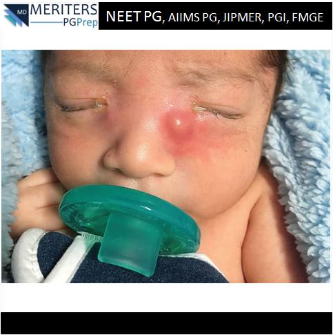 pg_prep's tweet photo. What is your diagnosis?
1. Trichiasis
2. Gonococcal conjunctivitis
3. Chlamydial conjunctivitis
4. Simple nasolacrimal duct obstruction
5. Acute dacrocystitis

#NEET_PG #AIIMS #JIPMER #PGI #DNB #Medicine #PG_Medical_Entrance #NEETPG #MedicalEntrance #Doctor #Medical #PGPrep https://t.co/UO1yJ4ID9Q
