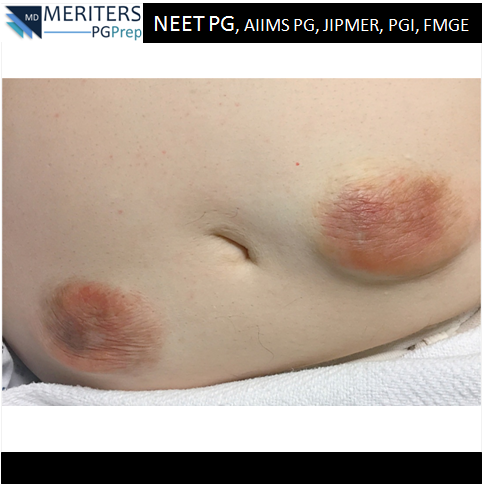 pg_prep's tweet photo. What is your diagnosis?
1. Abscess
2. Dermatofibrosarcoma protuberans
3. Hematoma
4. Insulin-induced lipohypertrophy
5. Nodular fasciitis
#ENT #Gynaecology #Medicine #Microbiology #Obstetrics #Opthalmology #Orthopaedics #paediatric #pathology #pharmacology #physiology #Psychiatry https://t.co/SA2cLYI15i