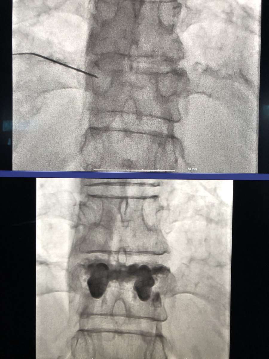 Arun Jagannathan (@dr_ajag) on Twitter photo Pain free (and 5mm taller) happy patient one hour post #spinejack #kyphoplasty! ๐ #irad #justjackit <a href="/_backtable/">BackTable Vascular and Interventional</a> <a href="/mjvillano/">Stryke V</a> <a href="/SIRspecialists/">Society of Interventional Radiology</a> Pain free (and 5mm taller) happy patient one hour post #spinejack #kyphoplasty! ๐ #irad #justjackit <a href="/_backtable/">BackTable Vascular and Interventional</a> <a href="/mjvillano/">Stryke V</a> <a href="/SIRspecialists/">Society of Interventional Radiology</a>