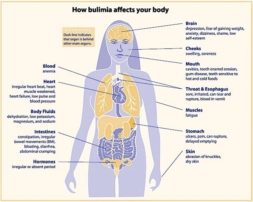 hiddendisorder's tweet image. Eating disorders don’t just allow you to lose weight, there are many serious affects that come with it. Below are some serious health problems that come along with bulimia and anorexia. Please share the info amongst your peers #educate #SLSSENG2D