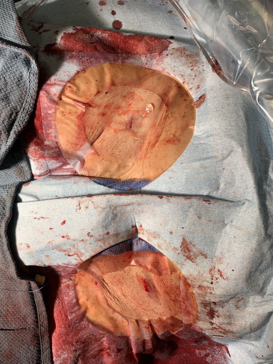 Completely perc EVAR by myself and  IR partner Nick Petruzzi @AMIRadiology. Home 18 hours later with band aids and no bruising. #staytuned #CompleteVascularCare <a href="/cek_VIR/">Christopher Kim</a> <a href="/SDhandMD/">Sabeen Dhand</a> <a href="/kmadass/">Kumar Madassery</a> <a href="/baobui99/">BAO BUI</a> <a href="/AlexCVIR/">Alexandria CVIR</a> <a href="/LukeWilkins_UVA/">Luke Wilkins, MD, FSIR</a> <a href="/SIRspecialists/">Society of Interventional Radiology</a> <a href="/SIR_ECS/">SIR ECS</a> <a href="/SIRRFS/">SIR RFS</a> <a href="/LessneVIR/">Mark Lessne, MD</a> <a href="/Penn_IR/">PennIR</a>