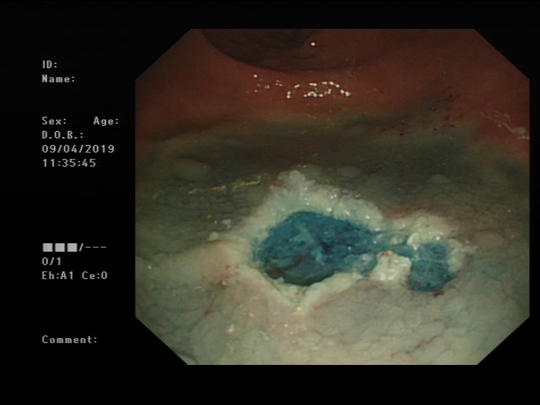 A rectal polyp found at bowel cancer screening colonoscopy, lifted ...