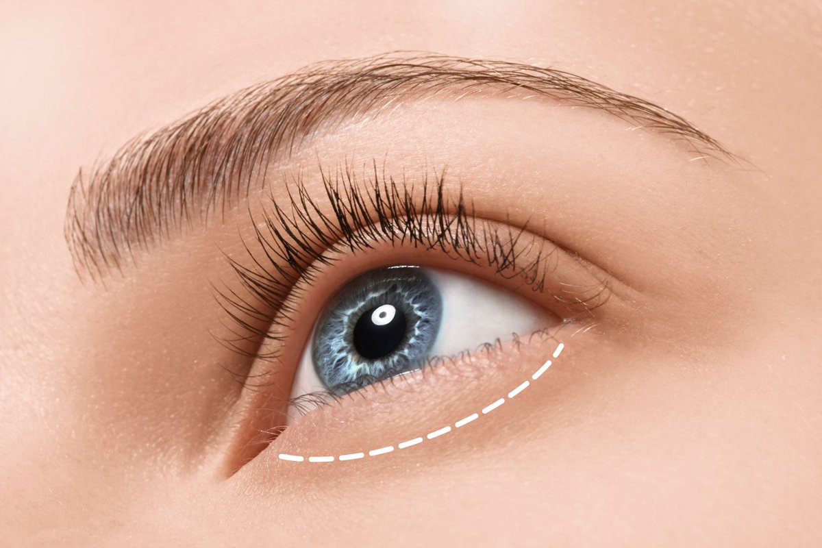 Eyelid Surgery Aftercare ==> fredricnewmanmd.com/blog/2018/02/0… #eyelidsurgery #Darien