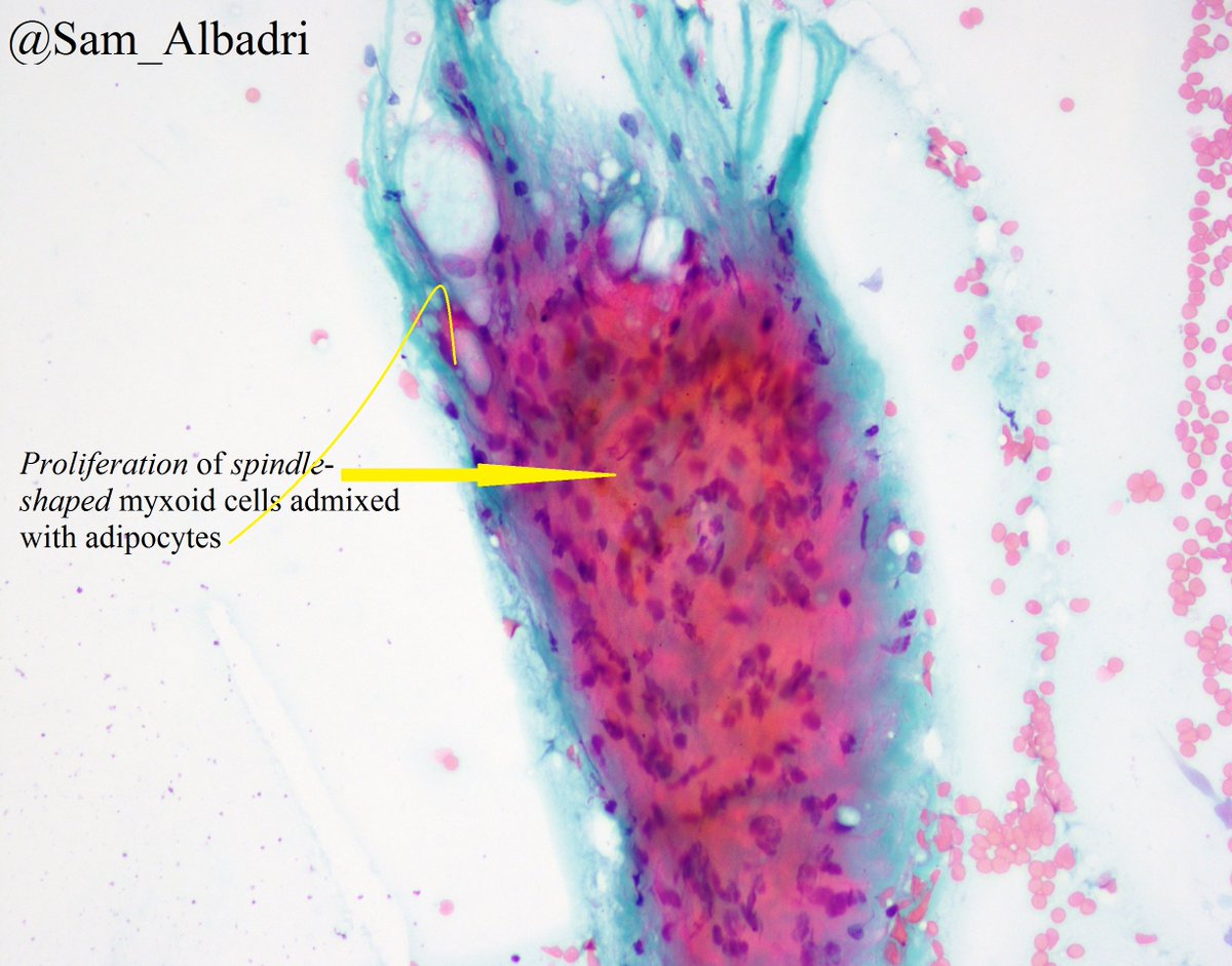 sam_albadri's tweet photo. 💎Perinephric myxoid pseudotumor of fat💎A new entity described @MayoClinicPath  usually occurs in patients with non-neoplastic renal disease. Check it out https://t.co/nfLzTut5Tb #BSTpath @Sinchita_Roy @pembeoltulu @ErikaBracamo316 @VijayPatho @SaudiCytopathol @edusqo #cytopath https://t.co/1z6hNpHHkG