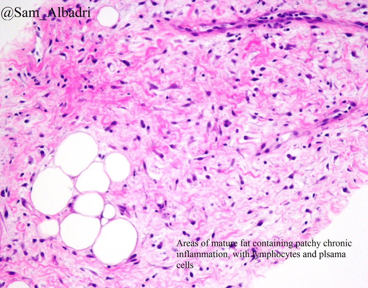 sam_albadri's tweet photo. 💎Perinephric myxoid pseudotumor of fat💎A new entity described @MayoClinicPath  usually occurs in patients with non-neoplastic renal disease. Check it out https://t.co/nfLzTut5Tb #BSTpath @Sinchita_Roy @pembeoltulu @ErikaBracamo316 @VijayPatho @SaudiCytopathol @edusqo #cytopath https://t.co/1z6hNpHHkG