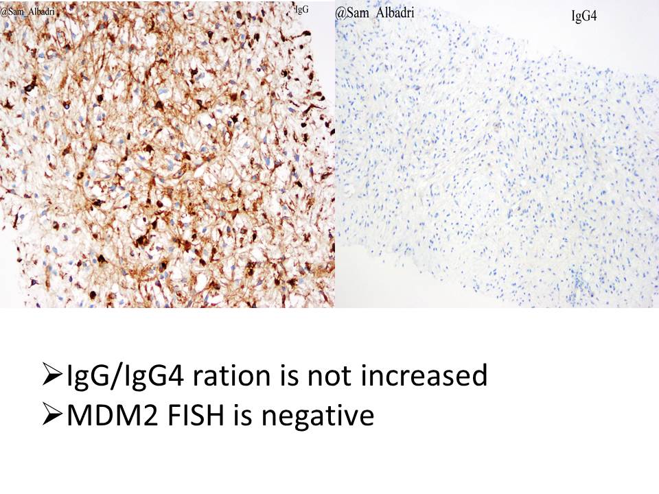 sam_albadri's tweet photo. 💎Perinephric myxoid pseudotumor of fat💎A new entity described @MayoClinicPath  usually occurs in patients with non-neoplastic renal disease. Check it out https://t.co/nfLzTut5Tb #BSTpath @Sinchita_Roy @pembeoltulu @ErikaBracamo316 @VijayPatho @SaudiCytopathol @edusqo #cytopath https://t.co/1z6hNpHHkG