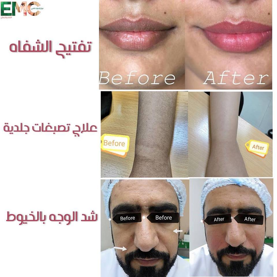 emc_oman's tweet photo. لا تفوتوا عروضنا المميزة
في جميع الفروع 
مع استشارة مجانية لطبيبة الأمراض النسائية و التوليد و التجميل النسائي.
للحجز: 24604540
MOH:150/2019 https://t.co/xnjaVHUbiT