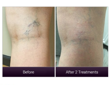 AFaceAntiAging's tweet photo. We can get rid or your spider veins in time for summer.  #LaserVeinRemoval. Call or text (254) 781-8169 for a free consultation https://t.co/pvVyJDNENO