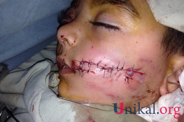 Bakıda it 4 yaşlı uşağın üzünü parçaladı
aypara.tv/xeber/bakida-i…