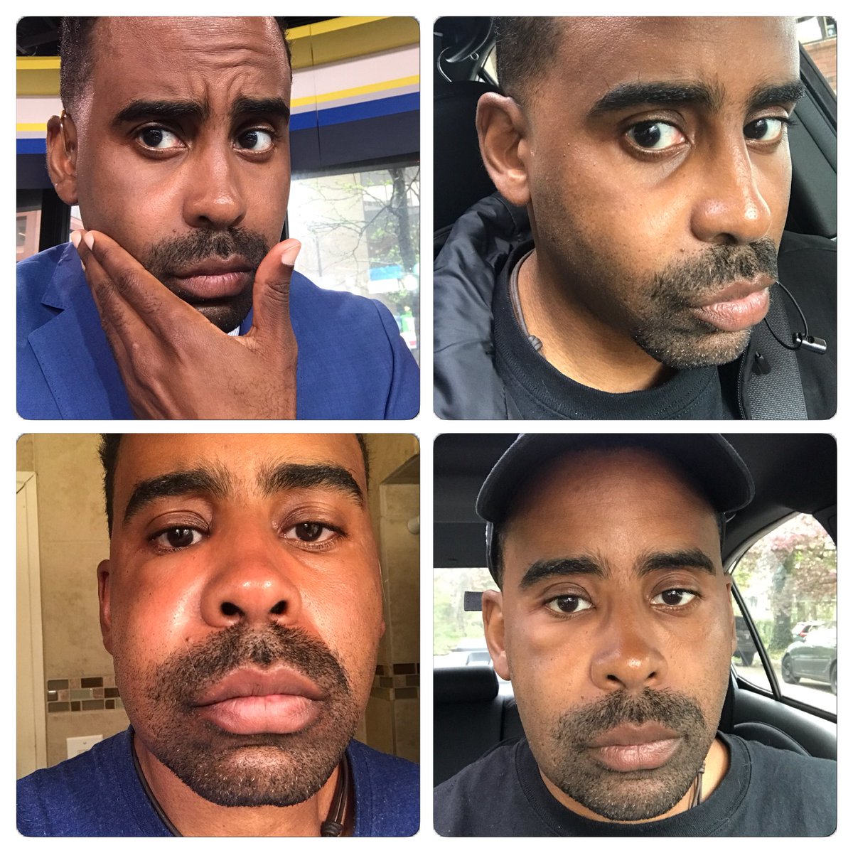 BillAFox29's tweet photo. The path of a tooth infection, top left to bottom right, yesterday before @fox29philly #fox29goodday until now. Looks like the swelling is starting to go down, no? #rootcanal #infection #IsMyFaceSwollen #nottvready https://t.co/9c85vpQu5K