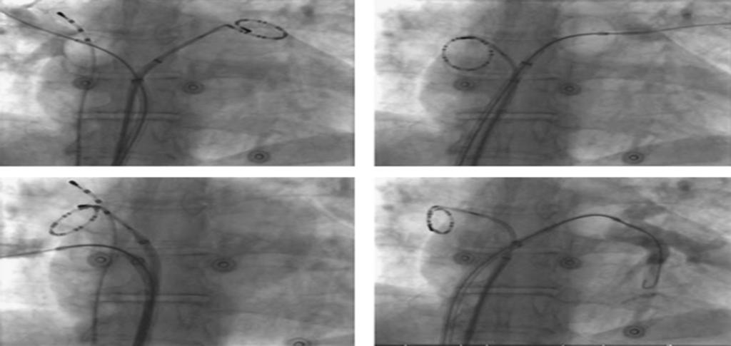 theheartorg's tweet photo. 📹  CABANA Trial,: catheter ablation was no different from drug therapy at reducing death, disabling stroke, serious bleeding, cardiac arrest in symptomatic #AFib. https://t.co/Gfqw7GjU5i #ACC19 https://t.co/tCifGUDqZp
