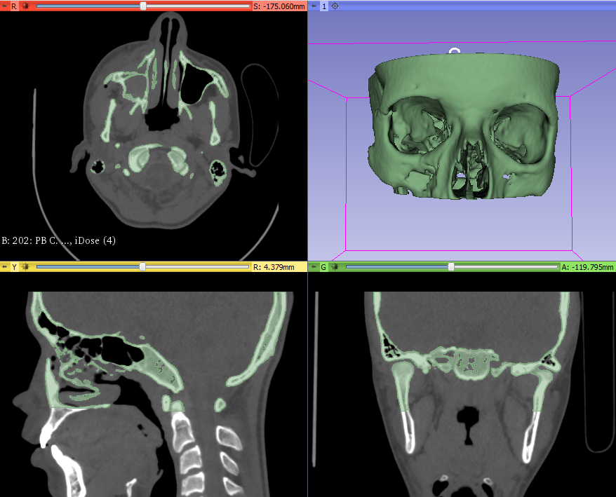 3d_maranon's tweet photo. 3D model of an orbit section printed as a mirror of the healthy side of the patient. This model will be the guide to mold the plates that will be used in the surgery to correct the fractures. #HospitalMarañon3D FabLab team: @rupermac @calvoharo_ja @diegotrap @sandrasv97 @kn_ord https://t.co/MObb0YS8ea