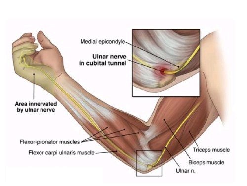 How Physio Can Provide Ulnar Nerve Pain Relief