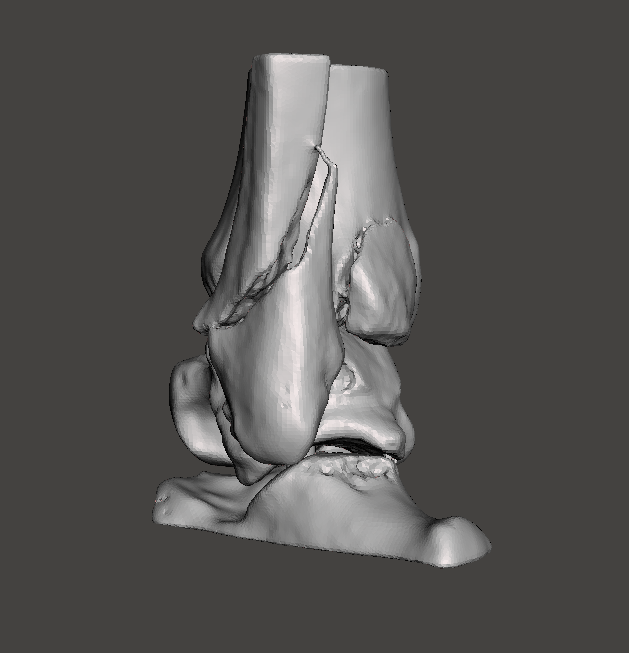 3d_maranon's tweet photo. This 3D model shows a fracture of the distal end of a tibia. This case will increase the repository of medical cases in the Hospital Gregorio Marañón. 
#HospitalMarañon3D FabLab team: @rupermac @calvoharo_ja @diegotrap @sandrasv97 @kn_ord https://t.co/8gbAktXZ5I
