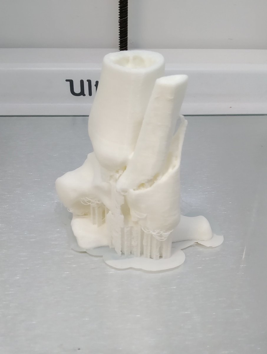 3d_maranon's tweet photo. This 3D model shows a fracture of the distal end of a tibia. This case will increase the repository of medical cases in the Hospital Gregorio Marañón. 
#HospitalMarañon3D FabLab team: @rupermac @calvoharo_ja @diegotrap @sandrasv97 @kn_ord https://t.co/8gbAktXZ5I