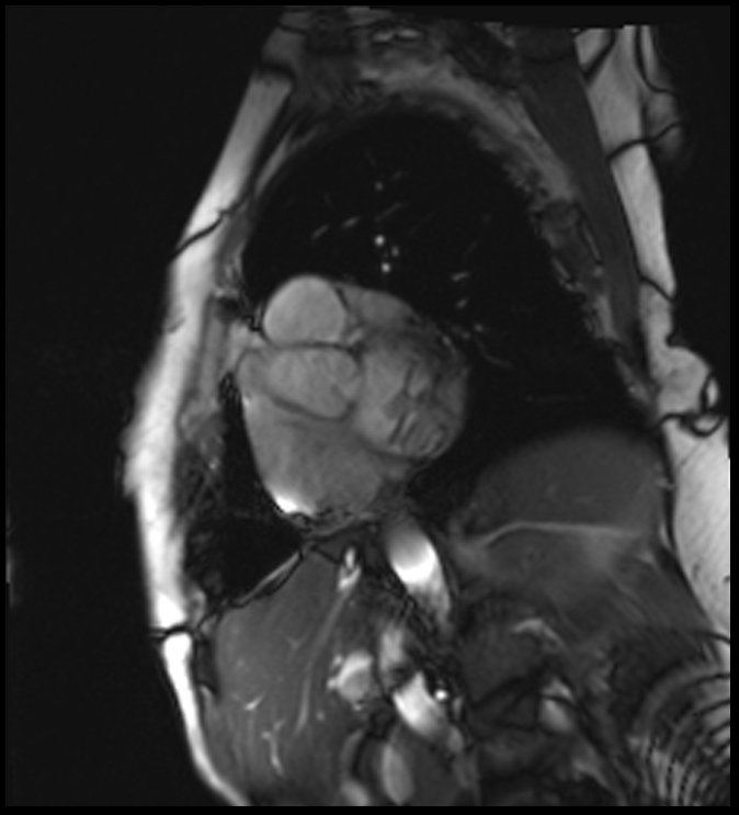 This week, we present you with a cardiac case! Click on the following link to scroll through every image in the case: hubs.ly/H0hw-q-0

Hx: This 77-year-old female presents with abnormal transthoracic echocardiogram.

#RadRes #Radiology #MRI #CardiacMRI