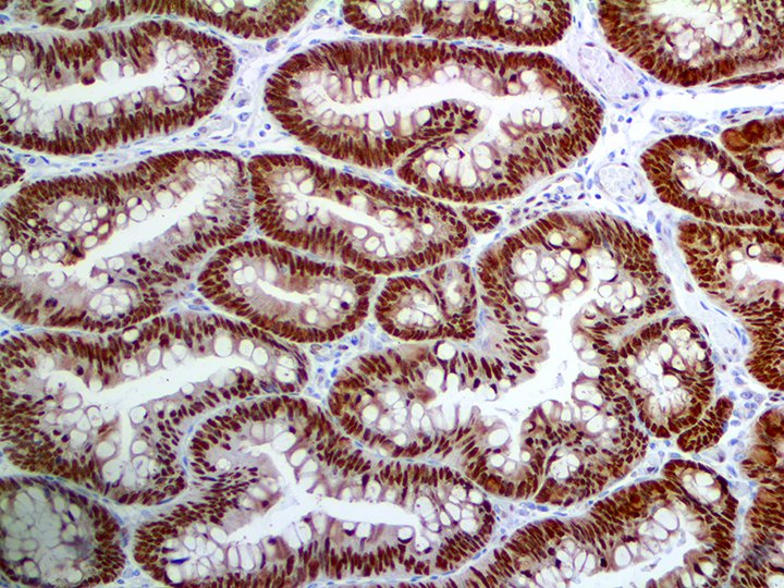 Bio_SB's tweet photo. Pic our our popular CDX2, #RMab, on colon adenocarcinoma tissue. Useful in distinguishing the gastrointestinal origin of Metastatic Adenocarcinomas and carcinoids.
#Antibody details here - https://t.co/diRO19aUGU
#histology #antibodies #pathology #Immuno #pathology #pathart https://t.co/tfmxuFDtq8