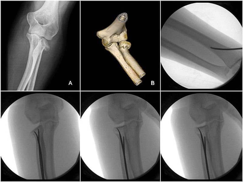 ALMATEC_SOCIAL's tweet photo. #INTRAMEDULLARY REDUCTION AND STABILIZATION TO TREAT #RADIALNECK #FRACTURES IN ADULTS
Isolated radial neck fractures are very rare and the majority can be treated conservatively. However, conservative treatment might result in malunion ...
https://t.co/xM6ZO5YbN9 … https://t.co/aAkyrLkdTt
