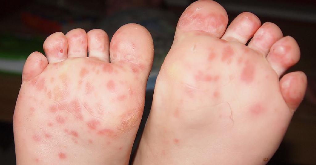 Webmd A Twitter Not Everyone With Hand Foot And Mouth Disease