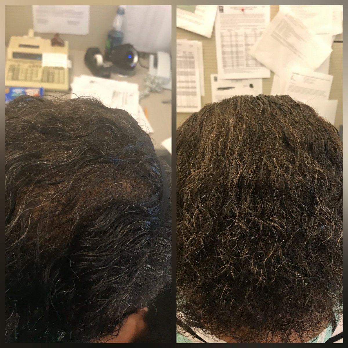 Regrowhair Hashtag On Twitter