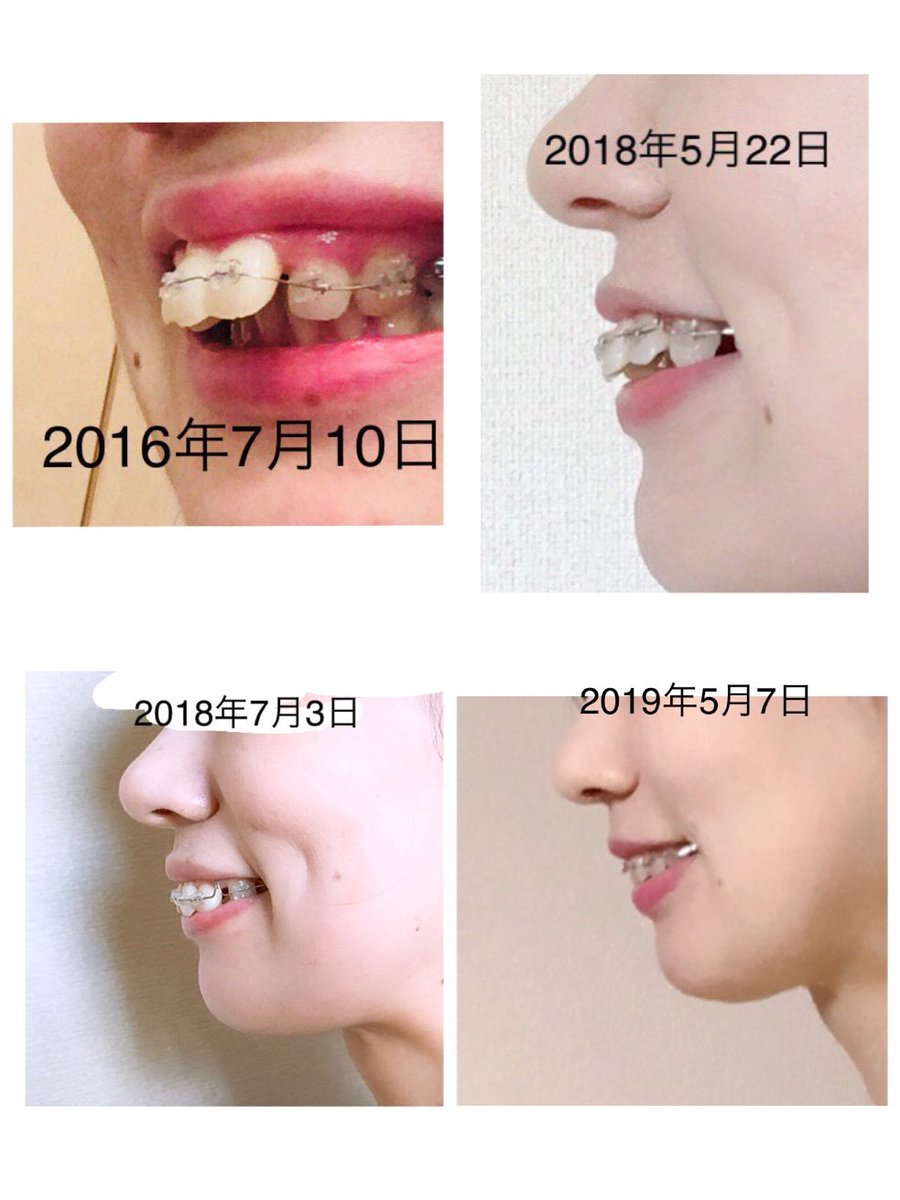 ふじか 歯列矯正済み あと1ミリくらい下がったら正常の範囲内に入れそうかな と思ってます 写真は上下の歯が分かりやすいように唇を剥き出して撮影したので 普通に笑っている時にはもう少し歯が目立たないかんじになっているはずです