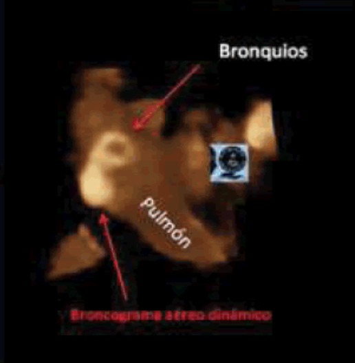 Lung Ultrasound in COPD and Bronchial Asthma-Measurements of Lung Deformation with our Novel Imaging Approach. 2015 / Remembering my first paper on three-dimensional bronchial ultrasound. 
#DiaMundialdelAsma2019 #WorldAsthmaDay #lungus #pocus #FOAMed asthma-and-bronchitis.imedpub.com/lung-ultrasoun…