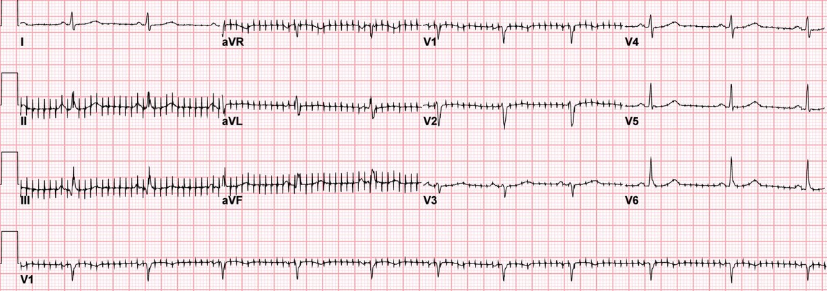 EM_RESUS's tweet image. Here's the #ECG of an elderly woman who was brought to the ER by EMS after calling 911 for shortness of breath.

What's her rhythm?