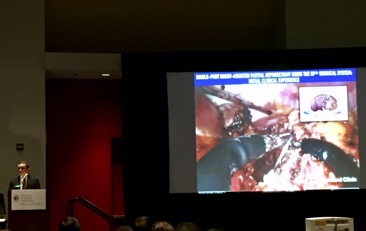 CleClinicUro's tweet image. #AUA19: @DrJDGaristo video presentation on early clinical experience with #SPRobot on behalf of his #ClevelandClinic team. Read the published research in @urogoldjournal: goldjournal.net/article/S0090-…