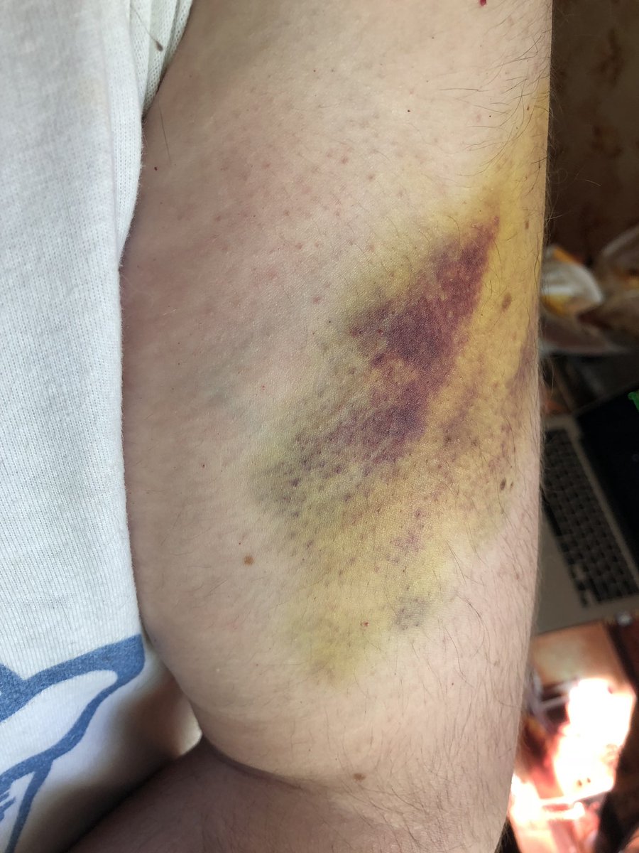 RecluseRu's tweet image. Прошёл ровно год с момента моего избиения этим жирным уёбком. Дело не заведено, куча отписок (последняя — нихуясе, отмена постановления в отказе в возбуждении дела, от 23 апреля 2019). На третьем фото ещё один уёбок, пытавшийся разбить мне камеру.