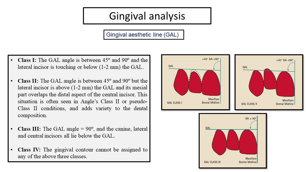 AbdullahAlshoai's tweet photo. #Restorative
#Esthetic
#Smile_Analysis
Gingival Analysis https://t.co/t3Z2Lkki6p