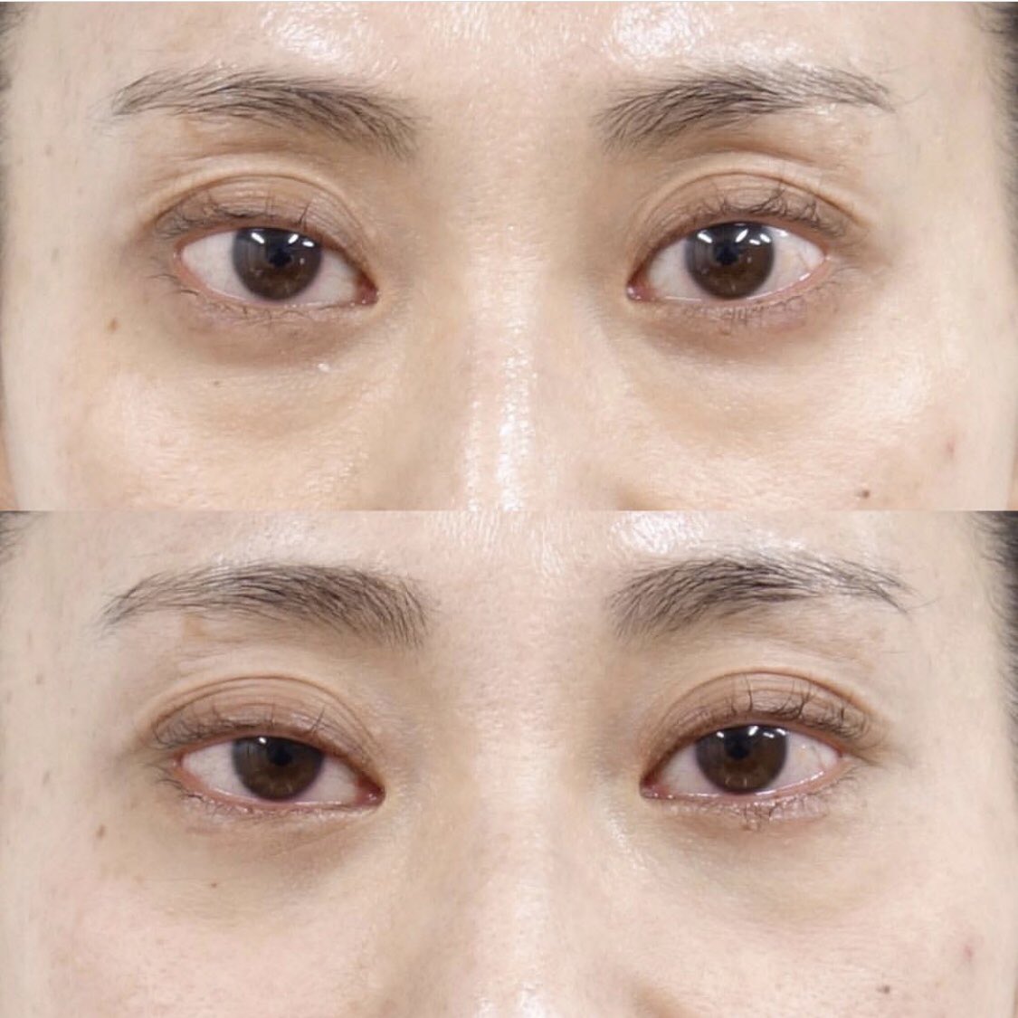 Select Clinic セレクトクリニック 連日たくさんのご予約 お問い合わせを頂いております 下眼瞼脱脂 若い方にも多いのです 目の下の脂肪 目の下の脂肪を取って クマを撃退 疲れたお顔が一気に若返り 明るい印象になります 詳細やご Select Clinic セレクトクリニック 連日たくさんのご予約 お問い合わせを頂いております 下眼瞼脱脂 若い方にも多いのです 目の下の脂肪 目の下の脂肪を取って クマを撃退 疲れたお顔が一気に若返り 明るい印象になります 詳細やご