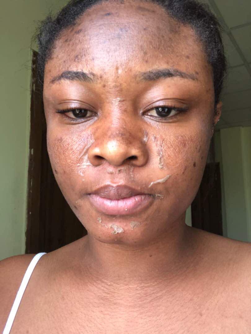 JSkinrepair's tweet photo. Progress after The Chemical Peel Treatment. It’s suitable for getting rid of blemishes, hyper-pigmentation, acne, oiliness, rough skin, black spots
We have the most appropriate skin treatment for YOU!
Call use today! 0278555478 https://t.co/YTtsNth09V