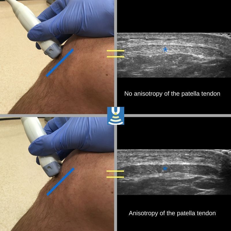 Deep infrapatellar bursitis The Ultrasound Site